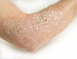 how to identify and treat dermatitis post shtf