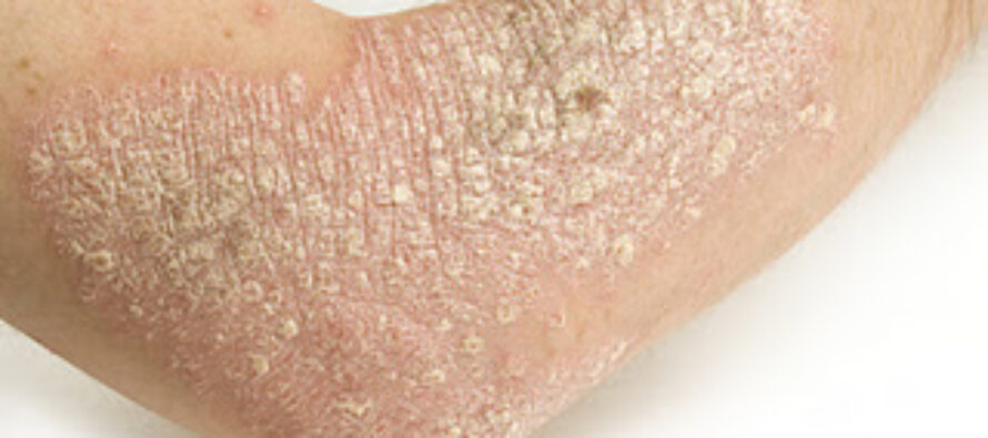 How To Identify and Treat Dermatitis In Doomsday Scenarios